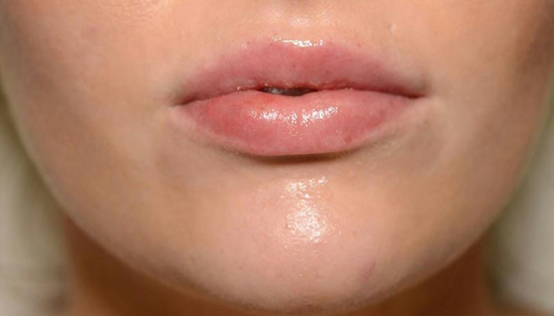 Lips Before & After Gallery - Patient 337694 - Image 2