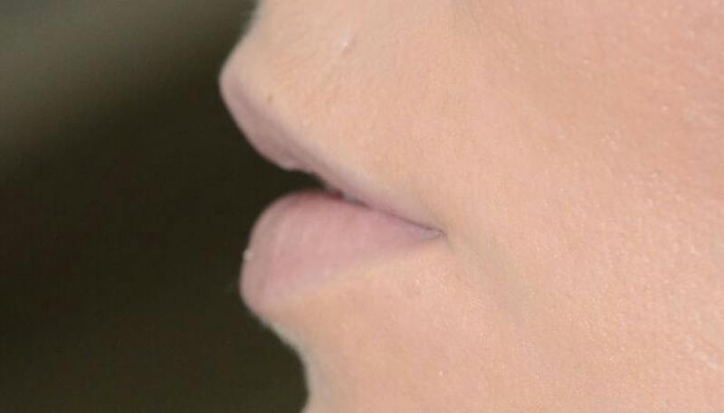 Lips Before & After Gallery - Patient 337694 - Image 3