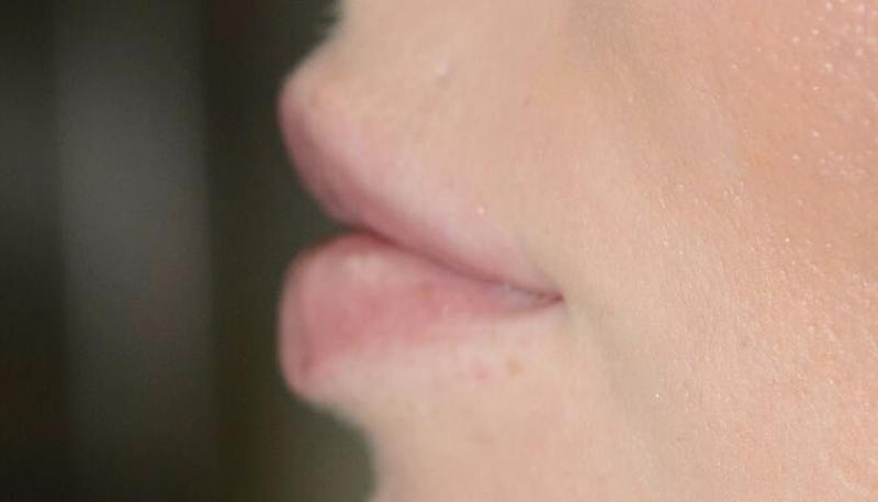 Lips Before & After Gallery - Patient 337694 - Image 4