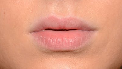 Lips Before & After Gallery - Patient 190034 - Image 1