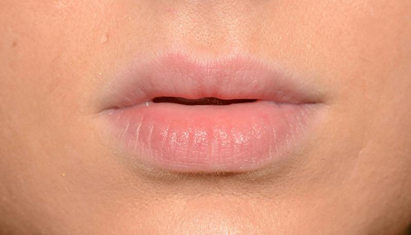 Lips Before & After Gallery - Patient 190034 - Image 1