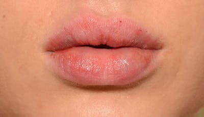 Lips Before & After Gallery - Patient 190034 - Image 2