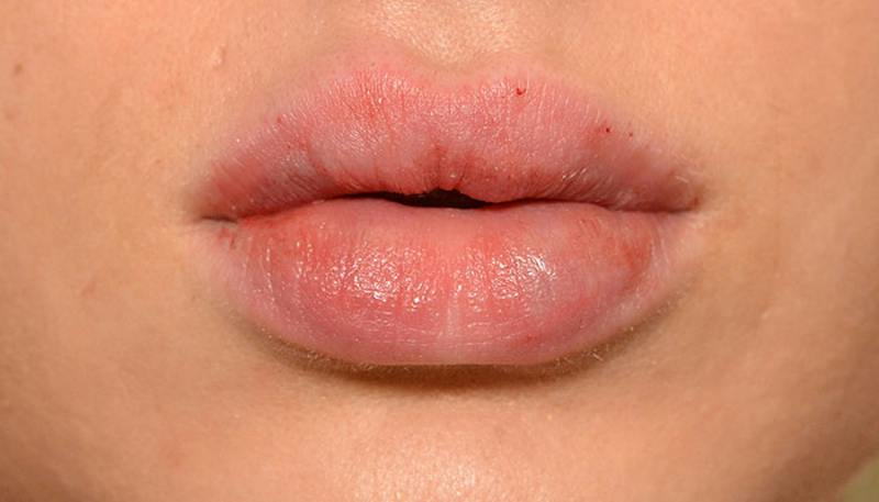Lips Before & After Gallery - Patient 190034 - Image 2