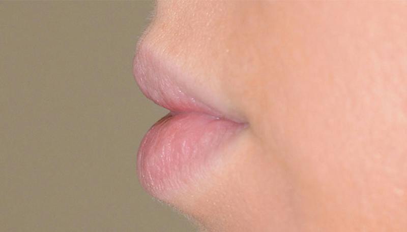 Lips Before & After Gallery - Patient 190034 - Image 3