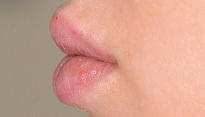Lips Before & After Gallery - Patient 190034 - Image 4