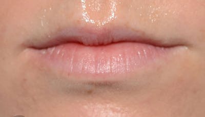 Lips Before & After Gallery - Patient 627243 - Image 1