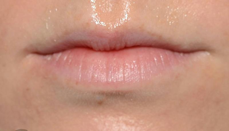 Lips Before & After Gallery - Patient 627243 - Image 1