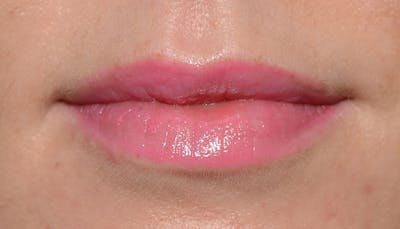 Lips Before & After Gallery - Patient 627243 - Image 2