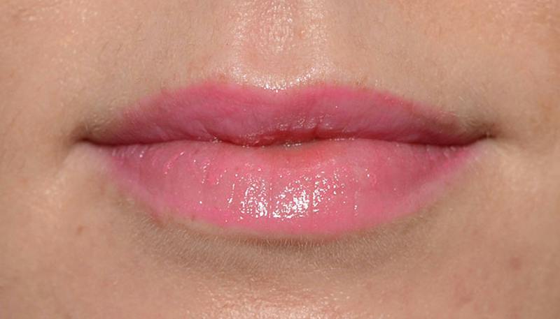 Lips Before & After Gallery - Patient 627243 - Image 2