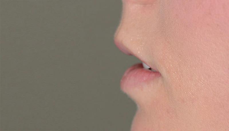 Lips Before & After Gallery - Patient 627243 - Image 3