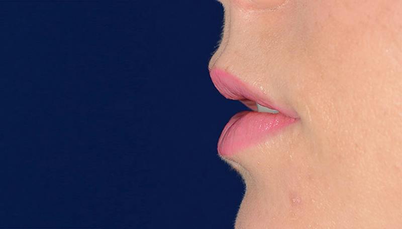 Lips Before & After Gallery - Patient 627243 - Image 4