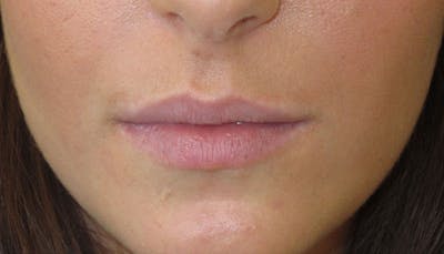 Lips Before & After Gallery - Patient 279181 - Image 1
