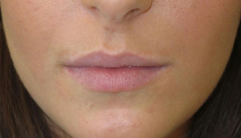 Lips Before & After Gallery - Patient 279181 - Image 1