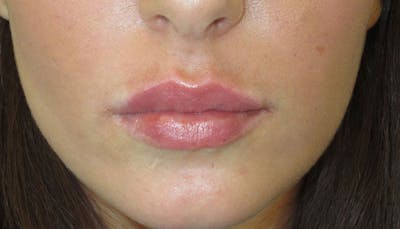 Lips Before & After Gallery - Patient 279181 - Image 2