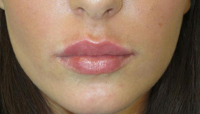 Lips Before & After Gallery - Patient 279181 - Image 2