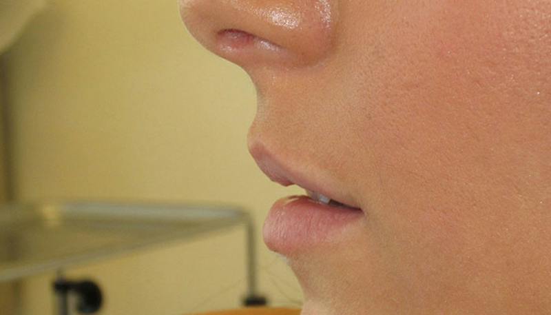 Lips Before & After Gallery - Patient 279181 - Image 3