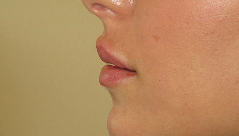 Lips Before & After Gallery - Patient 279181 - Image 4