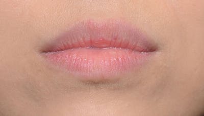Lips Before & After Gallery - Patient 117216 - Image 1