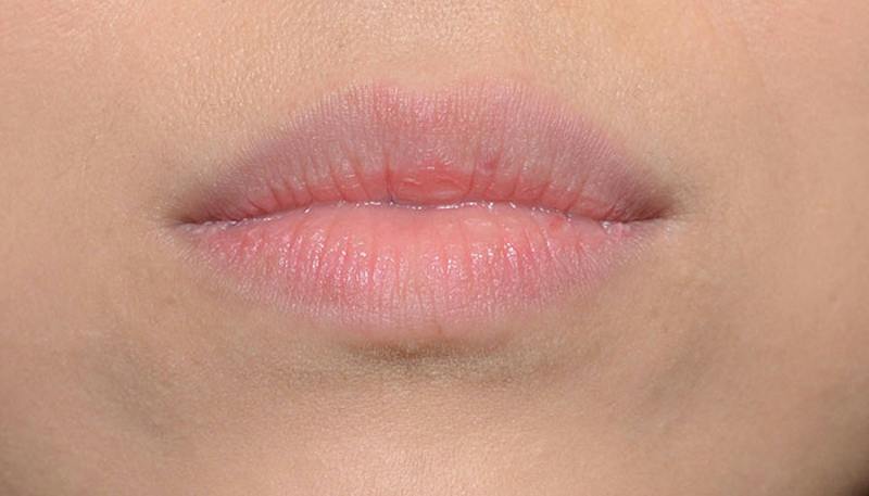 Lips Before & After Gallery - Patient 117216 - Image 1