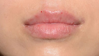Lips Before & After Gallery - Patient 117216 - Image 2