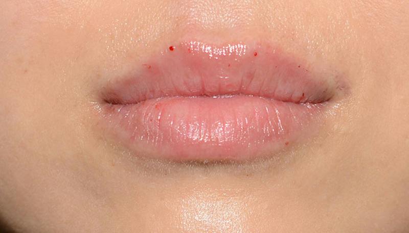 Lips Before & After Gallery - Patient 117216 - Image 2