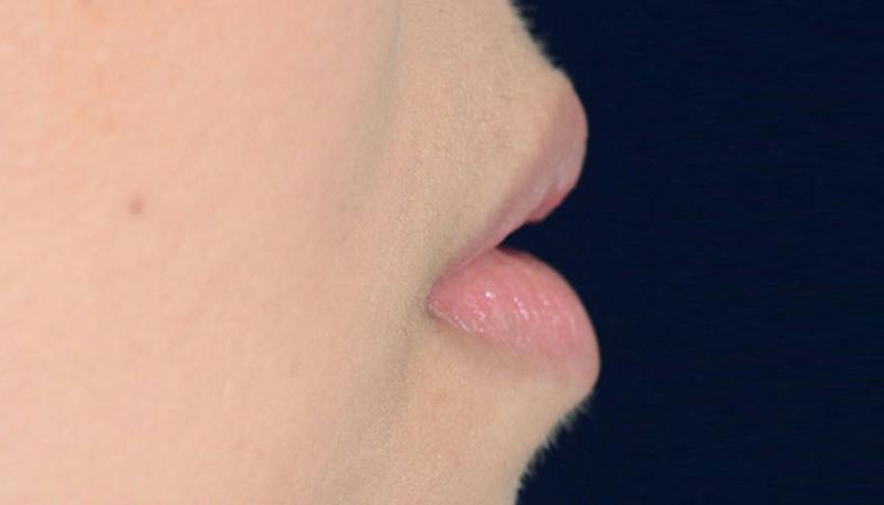 Lips Before & After Gallery - Patient 117216 - Image 3
