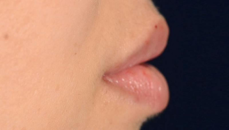 Lips Before & After Gallery - Patient 117216 - Image 4