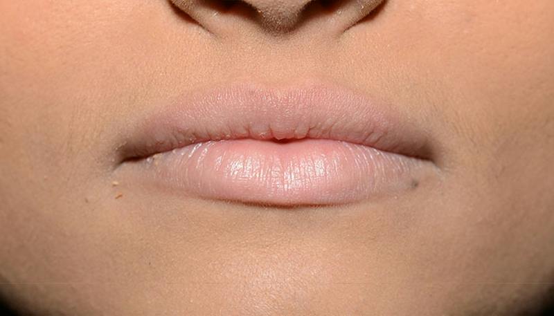 Lips Before & After Gallery - Patient 130229 - Image 1