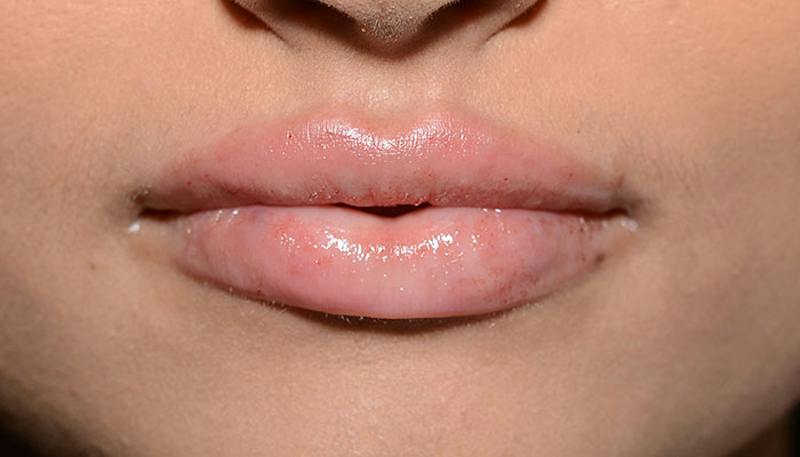 Lips Before & After Gallery - Patient 130229 - Image 2