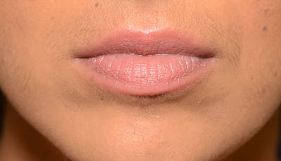 Lips Before & After Gallery - Patient 210946 - Image 1