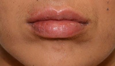 Lips Before & After Gallery - Patient 210946 - Image 2