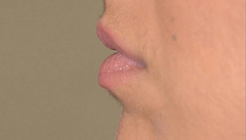 Lips Before & After Gallery - Patient 210946 - Image 3