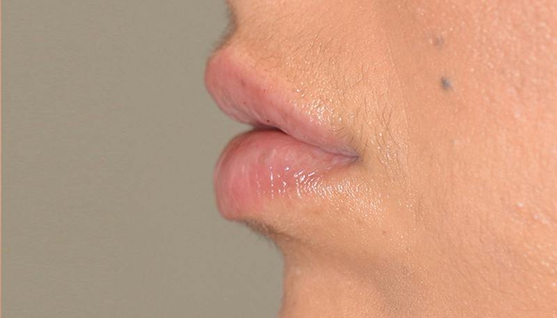 Lips Before & After Gallery - Patient 210946 - Image 4