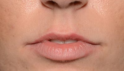 Lips Before & After Gallery - Patient 397972 - Image 1