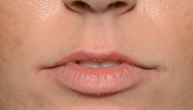 Lips Before & After Gallery - Patient 397972 - Image 1