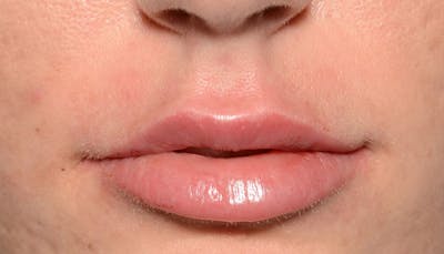 Lips Before & After Gallery - Patient 397972 - Image 2