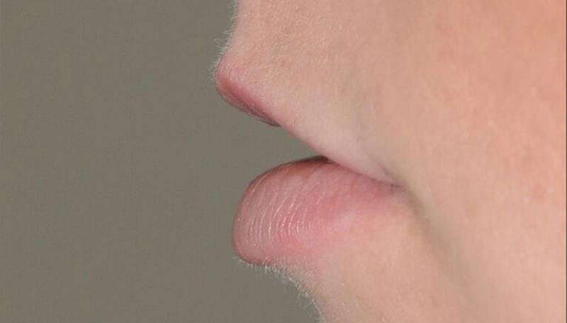 Lips Before & After Gallery - Patient 397972 - Image 3