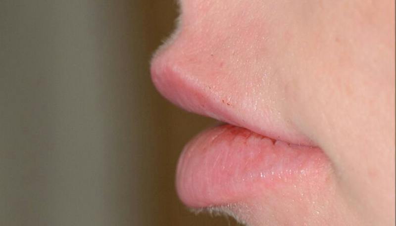 Lips Before & After Gallery - Patient 397972 - Image 4