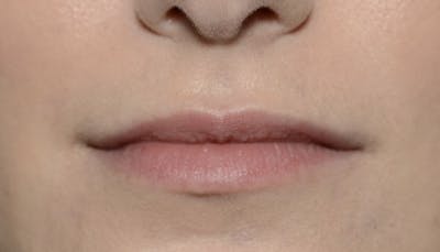 Lips Before & After Gallery - Patient 403141 - Image 1