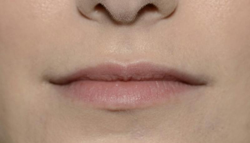 Lips Before & After Gallery - Patient 403141 - Image 1