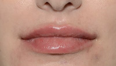 Lips Before & After Gallery - Patient 403141 - Image 2
