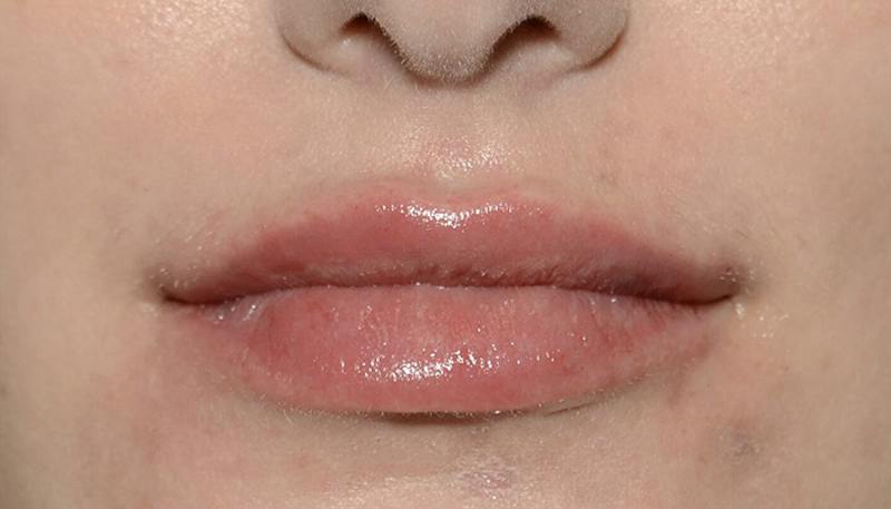 Lips Before & After Gallery - Patient 403141 - Image 2