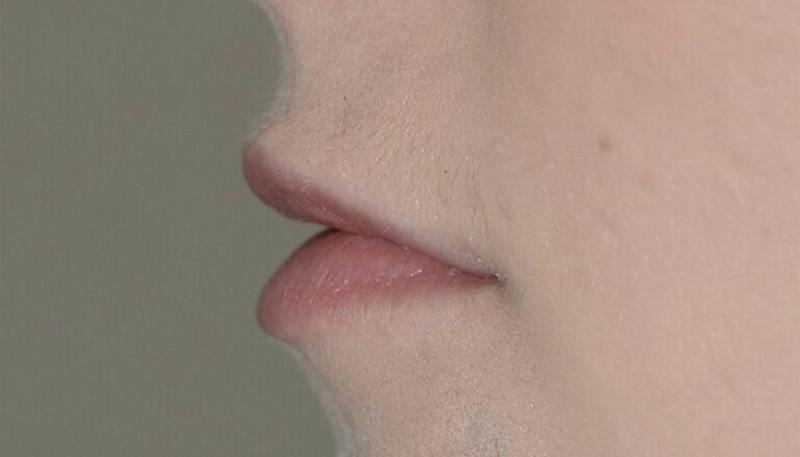 Lips Before & After Gallery - Patient 403141 - Image 3