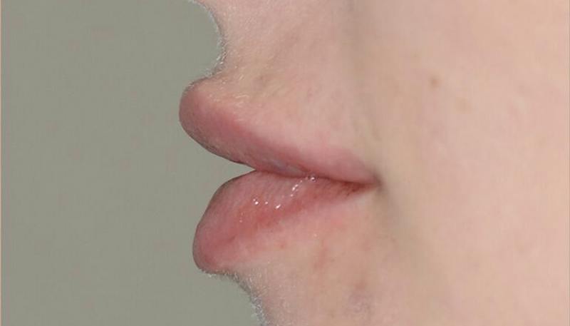 Lips Before & After Gallery - Patient 403141 - Image 4