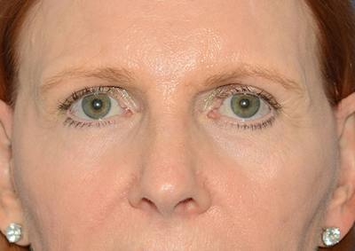 Brow Lift Before & After Gallery - Patient 366625 - Image 1