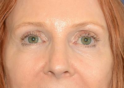 Brow Lift Before & After Gallery - Patient 366625 - Image 2