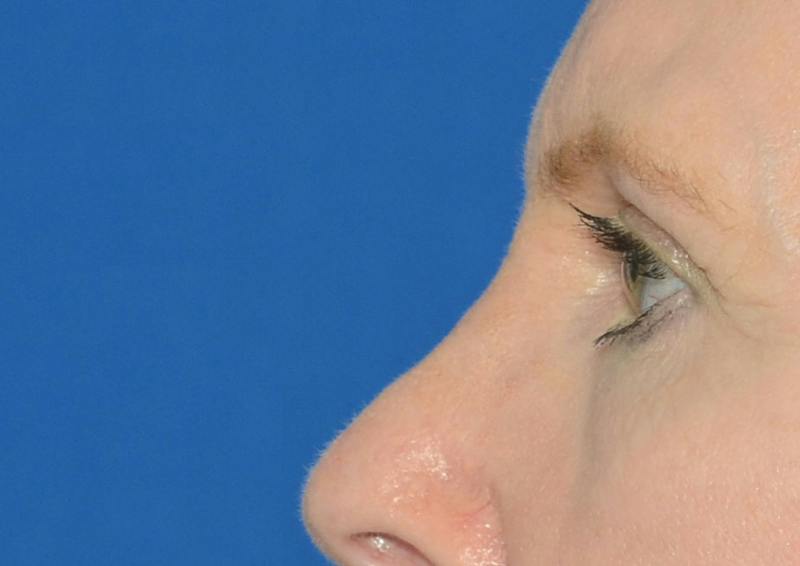 Brow Lift Before & After Gallery - Patient 366625 - Image 3