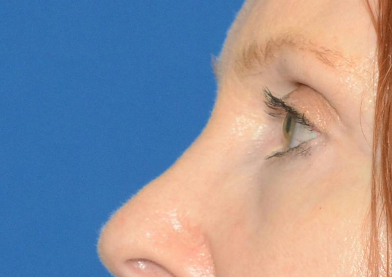 Brow Lift Before & After Gallery - Patient 366625 - Image 4