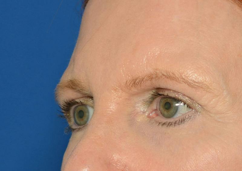 Brow Lift Before & After Gallery - Patient 366625 - Image 5