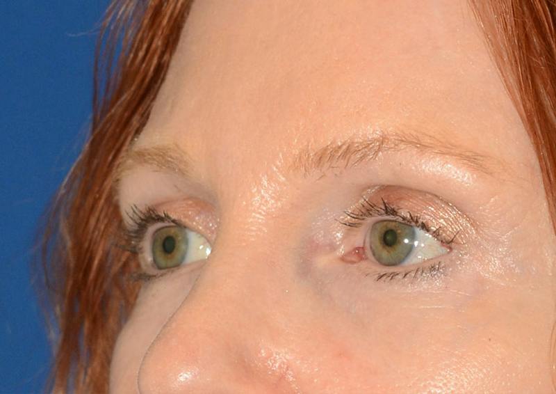 Brow Lift Before & After Gallery - Patient 366625 - Image 6